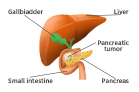 pancreatic-cancer img